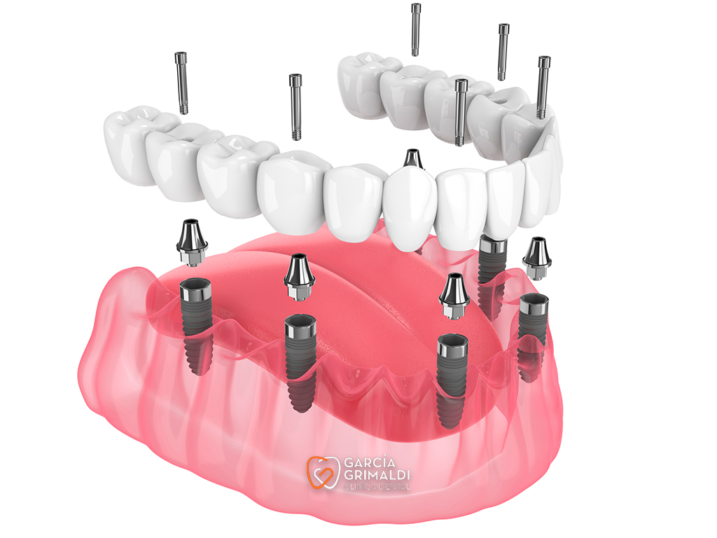 Implantología de Carga Inmediata Dientes en un Día All-on-6