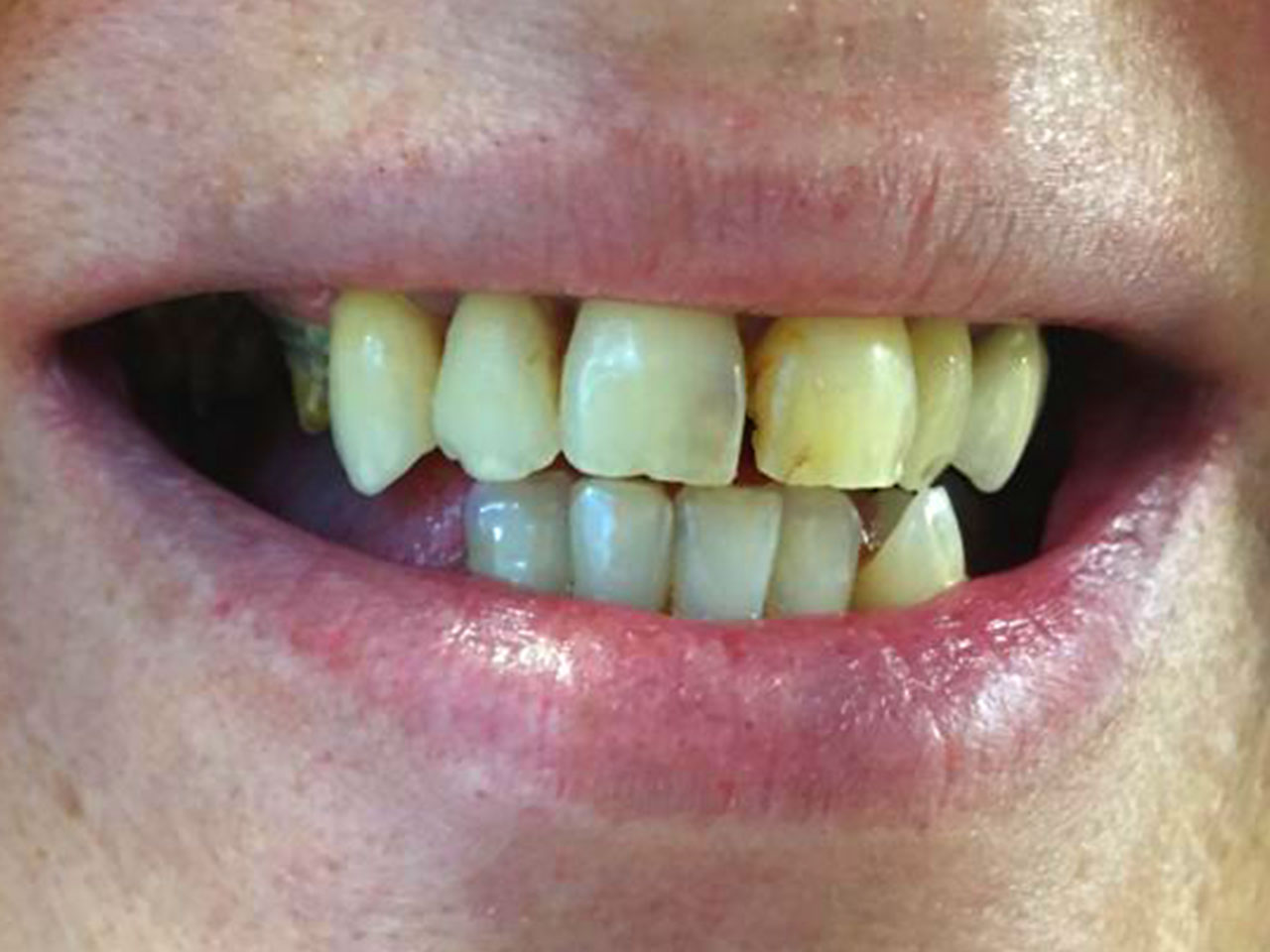 boca antes de los implantes dentales