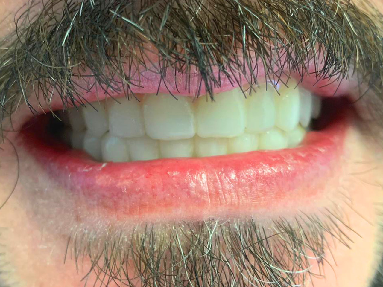 boca después de los implantes dentales